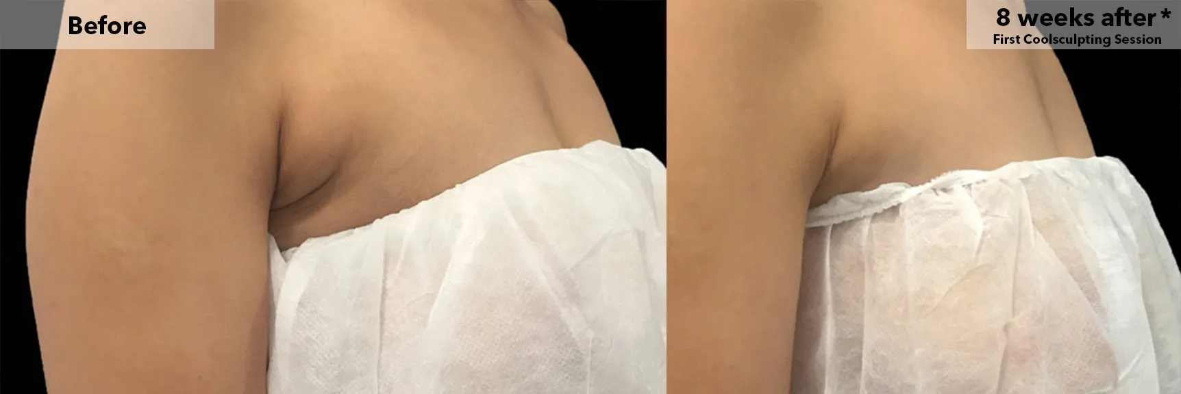 Bra line area before and after CoolSculpting fat freezing at Cool Clinic in Amsterdam