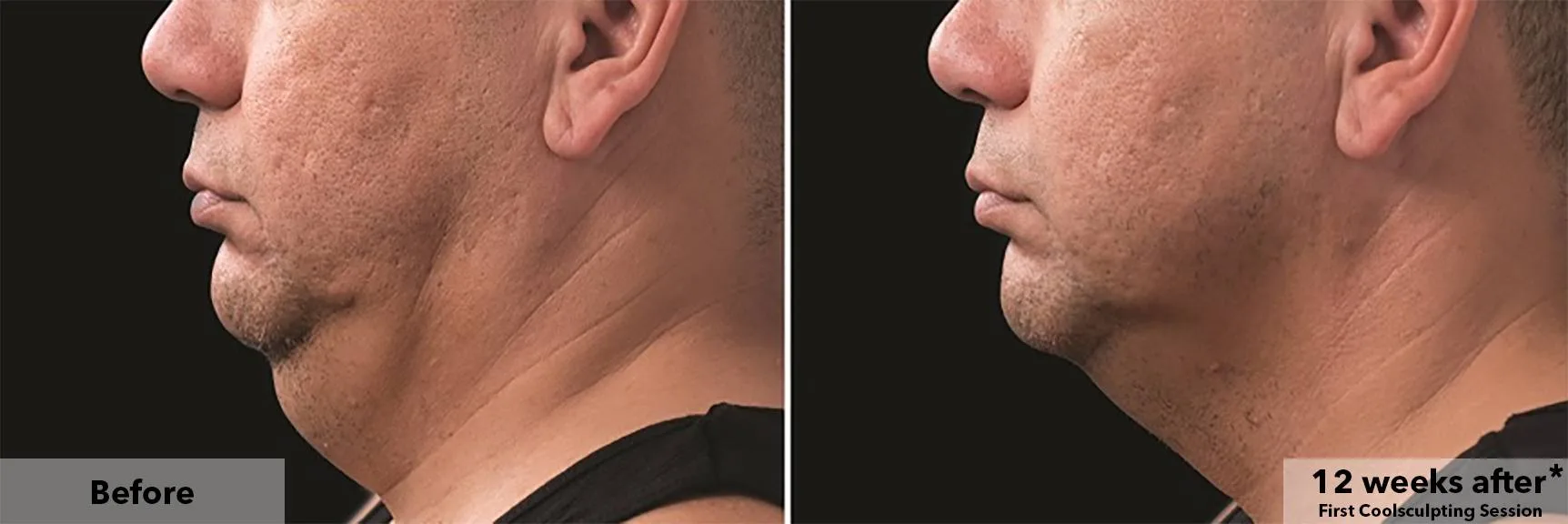 Chin and jawline in profile before and after CoolSculpting fat freezing at Cool Clinic in Amsterdam