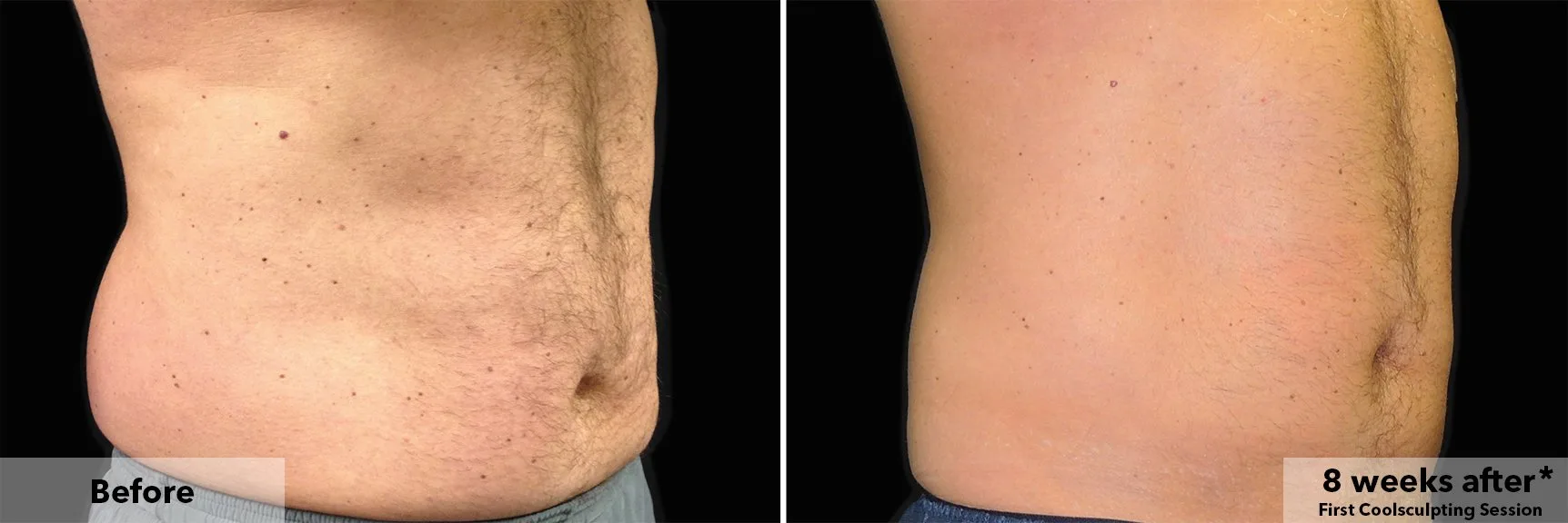 Abdomen before and after CoolSculpting fat freezing at Cool Clinic in Amsterdam