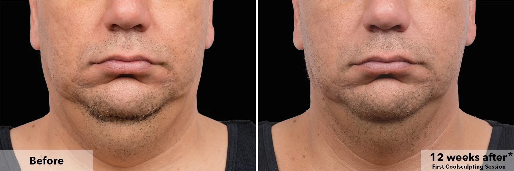 Chin and jawline before and after CoolSculpting fat freezing at Cool Clinic in Amsterdam
