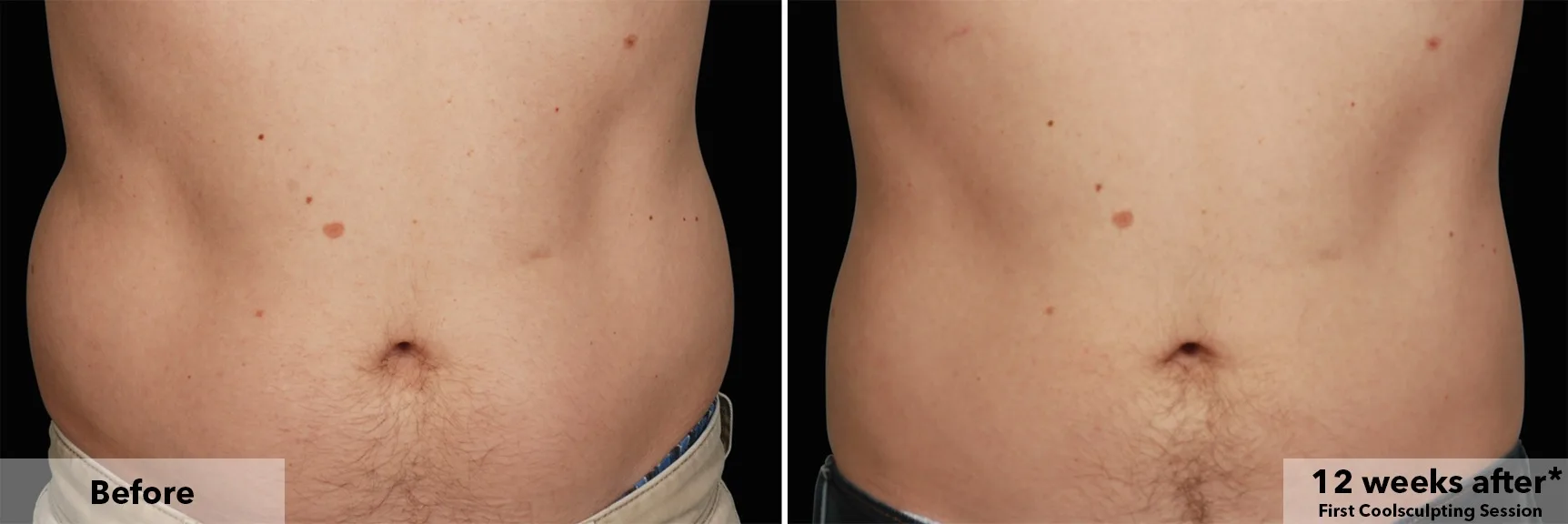 Abdomen before and after CoolSculpting fat freezing at Cool Clinic in Amsterdam