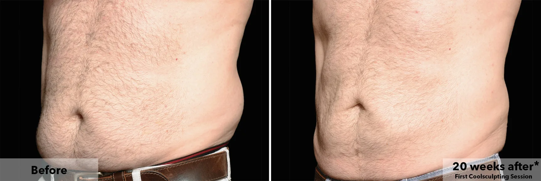 Abdomen before and after CoolSculpting fat freezing at Cool Clinic in Amsterdam