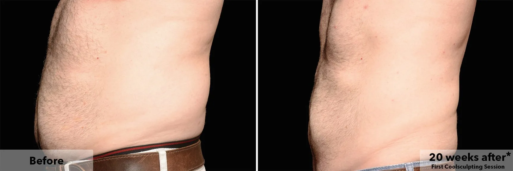 Abdomen before and after CoolSculpting fat freezing at Cool Clinic in Amsterdam
