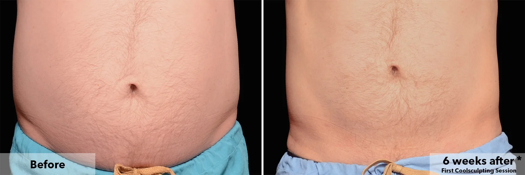 Abdomen before and after CoolSculpting fat freezing at Cool Clinic in Amsterdam