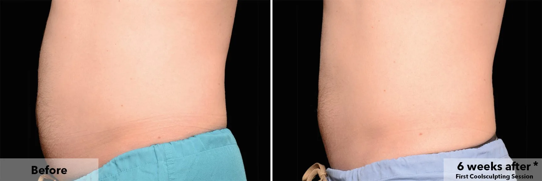 Abdomen before and after CoolSculpting fat freezing at Cool Clinic in Amsterdam