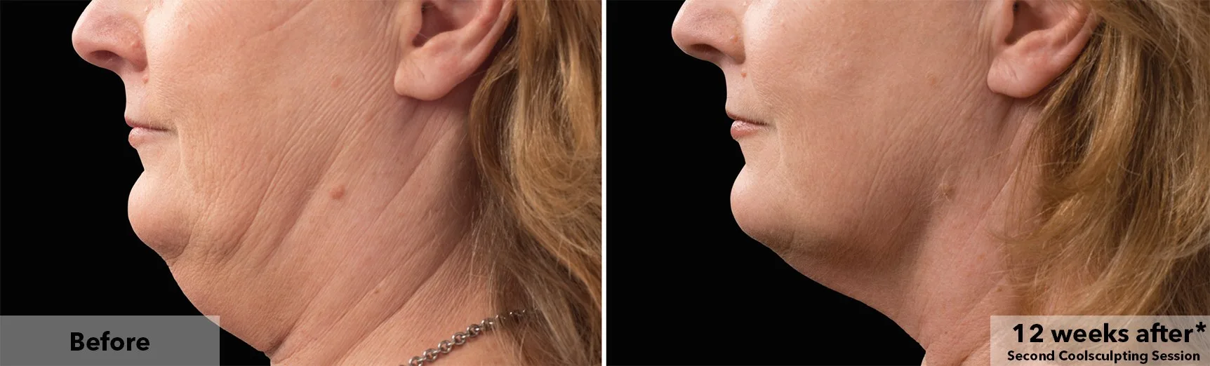 Chin and jawline before and after CoolSculpting fat freezing at Cool Clinic in Amsterdam