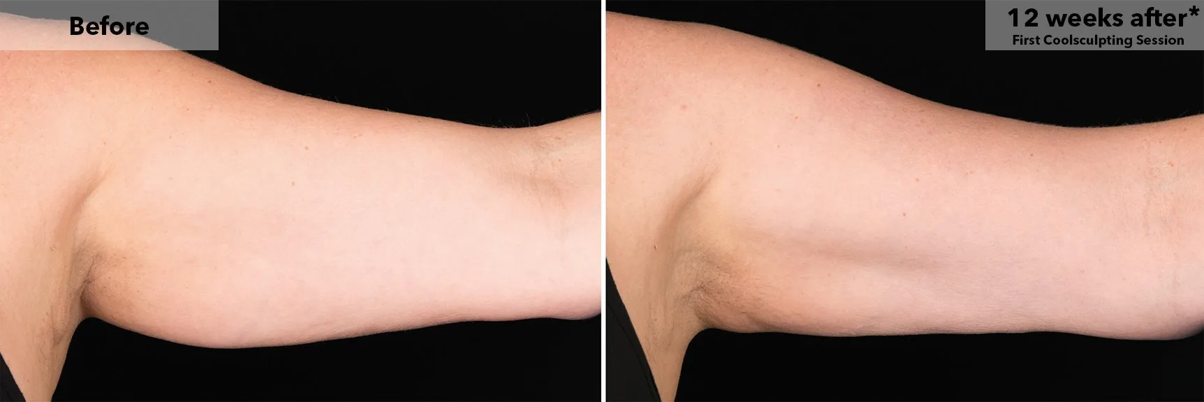 Upper arm before and after CoolSculpting fat freezing at Cool Clinic in Amsterdam