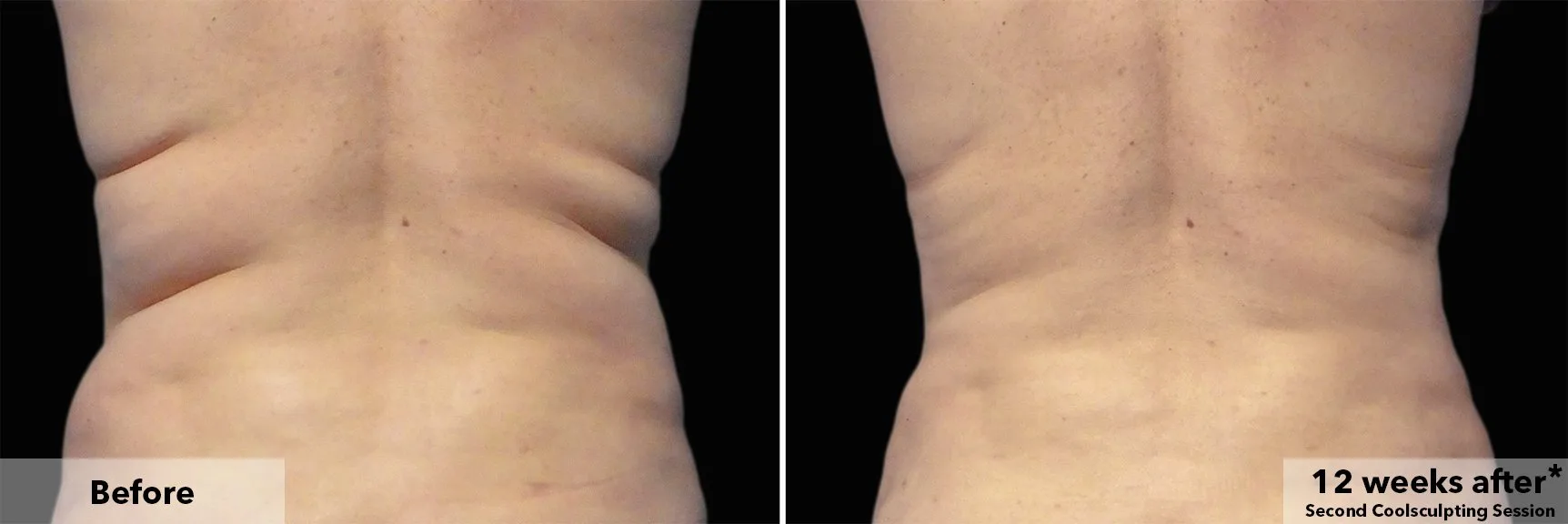 Flanks from behind before and after CoolSculpting fat freezing at Cool Clinic in Amsterdam