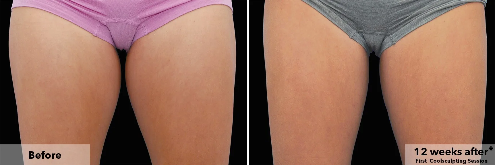 Inner thighs before and after CoolSculpting fat freezing at Cool Clinic in Amsterdam