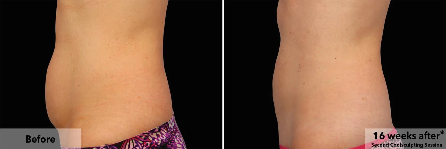 Abdomen in profile before and after CoolSculpting fat freezing at Cool Clinic in Amsterdam