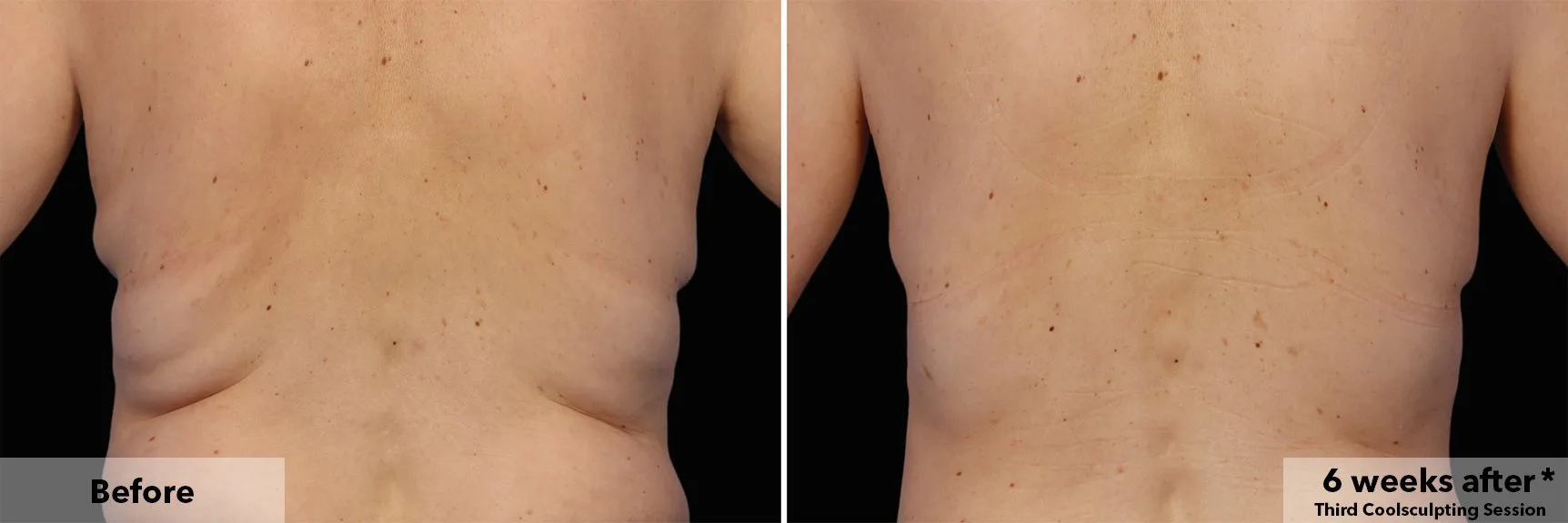 Flanks from behind before and after CoolSculpting fat freezing at Cool Clinic in Amsterdam