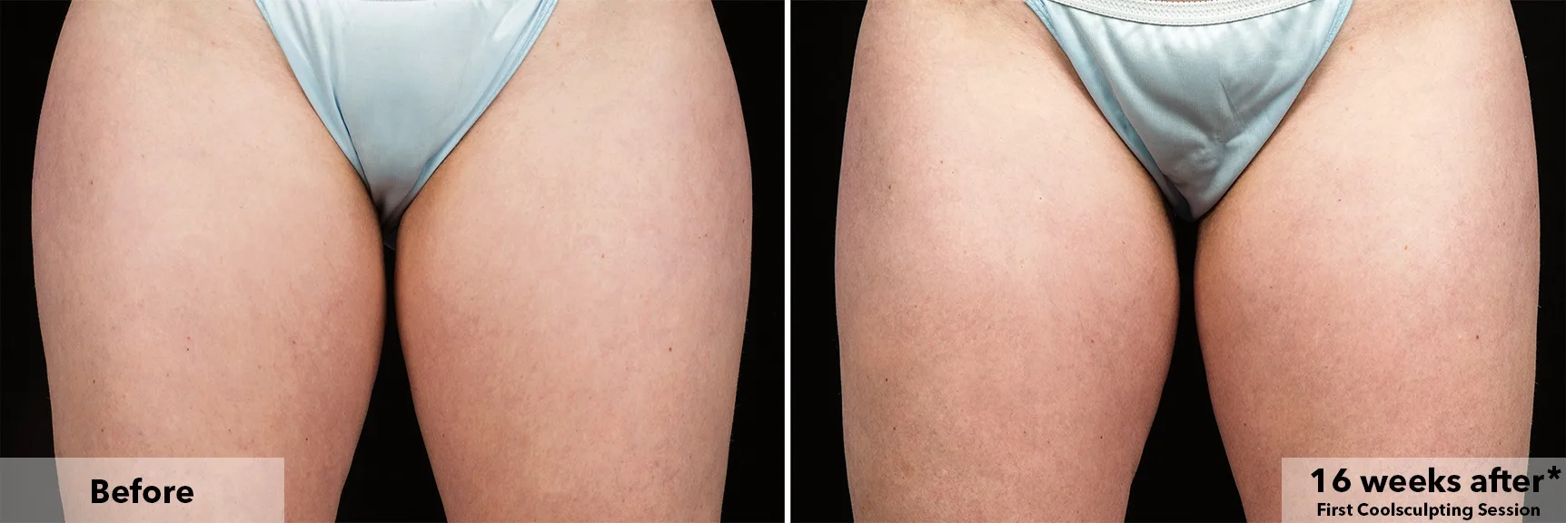 Inner thighs before and after CoolSculpting fat freezing at Cool Clinic in Amsterdam