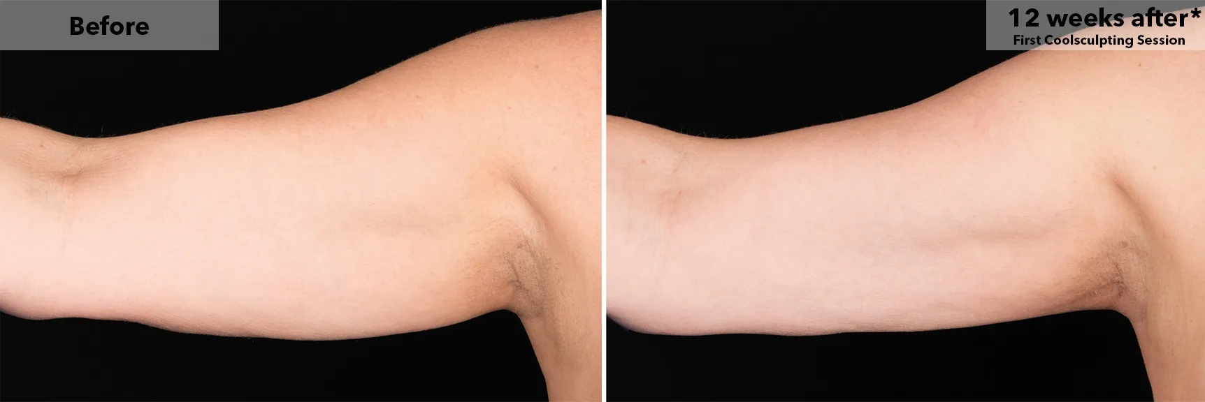 Upper arm before and after CoolSculpting fat freezing at Cool Clinic in Amsterdam