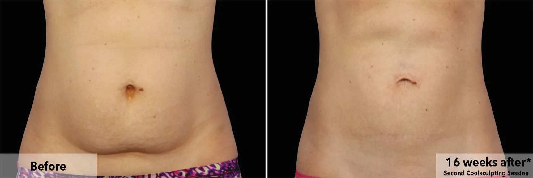 Abdomen before and after CoolSculpting fat freezing at Cool Clinic in Amsterdam