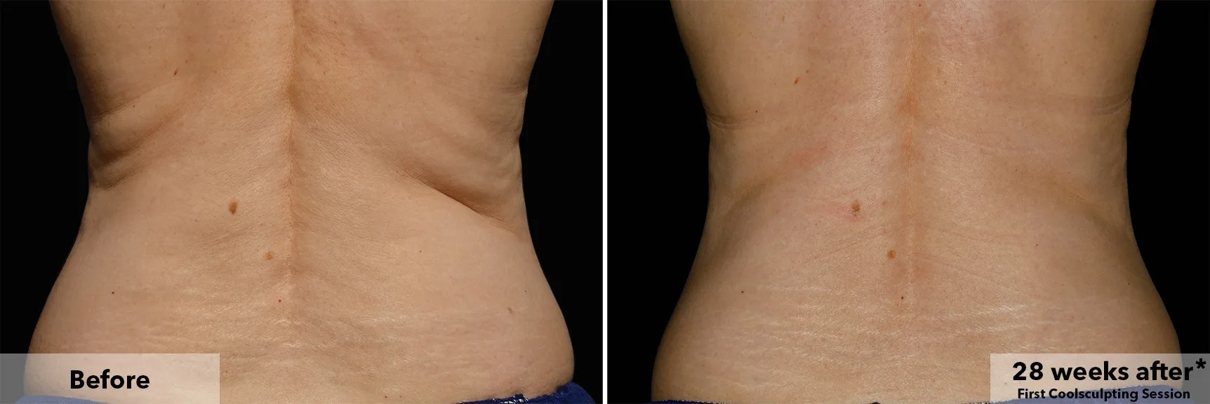 Flanks from behind before and after CoolSculpting fat freezing at Cool Clinic in Amsterdam