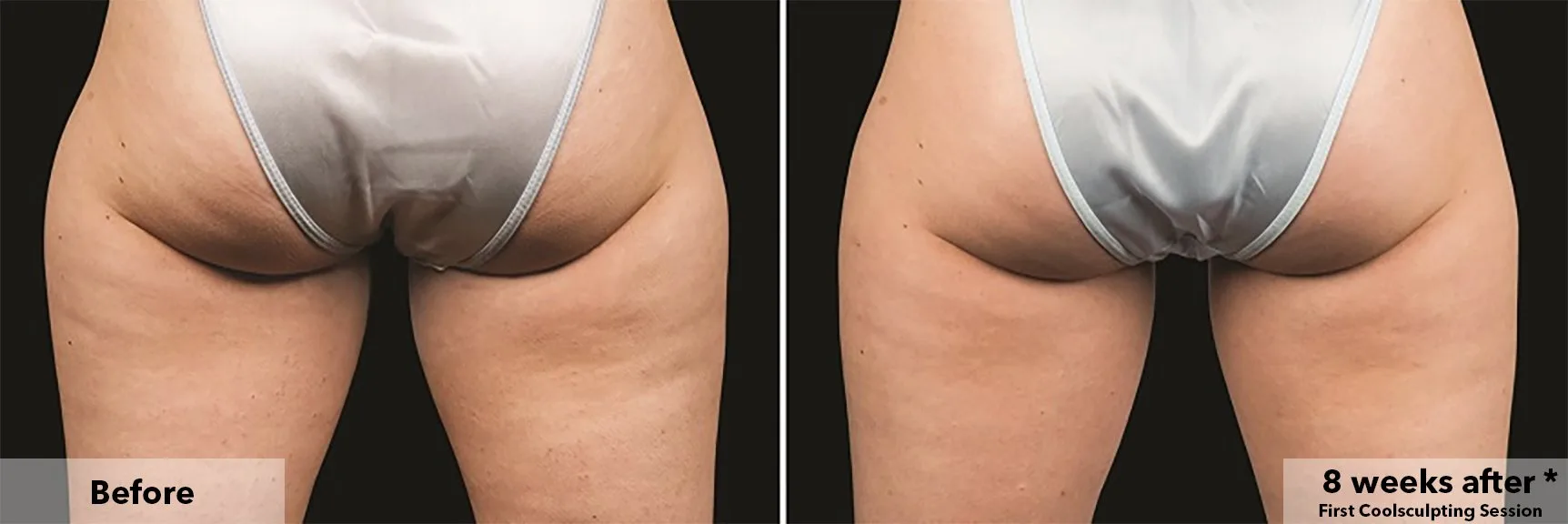 Thighs from behind before and after CoolSculpting fat freezing at Cool Clinic in Amsterdam