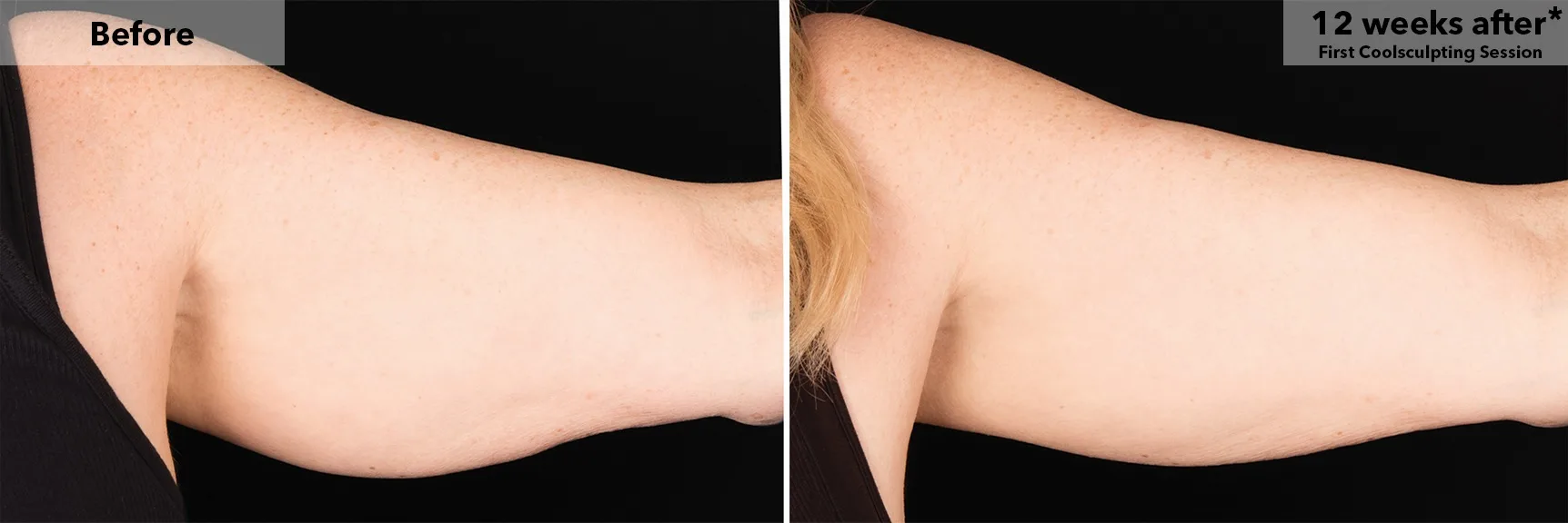 Upper arm before and after CoolSculpting fat freezing at Cool Clinic in Amsterdam