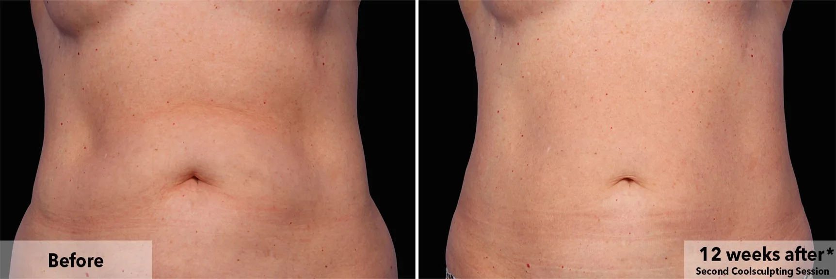 Abdomen before and after CoolSculpting fat freezing at Cool Clinic in Amsterdam