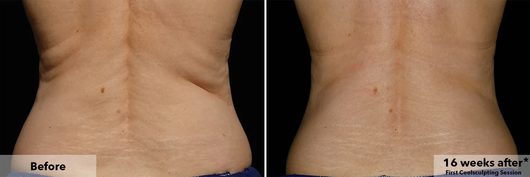 Flanks from behind before and after CoolSculpting fat freezing at Cool Clinic in Amsterdam