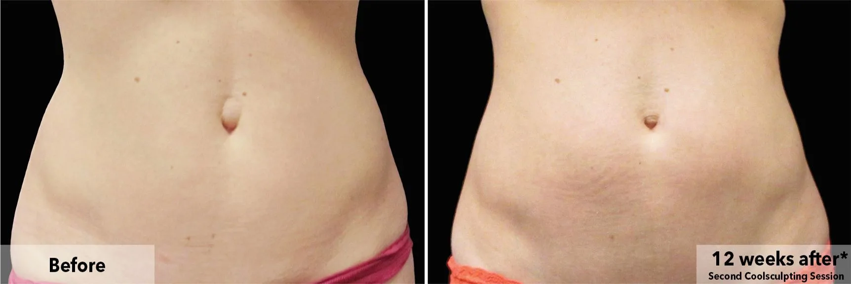 Abdomen before and after CoolSculpting fat freezing at Cool Clinic in Amsterdam
