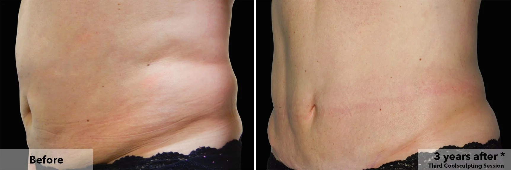 Abdomen in profile before and after CoolSculpting fat freezing at Cool Clinic in Amsterdam