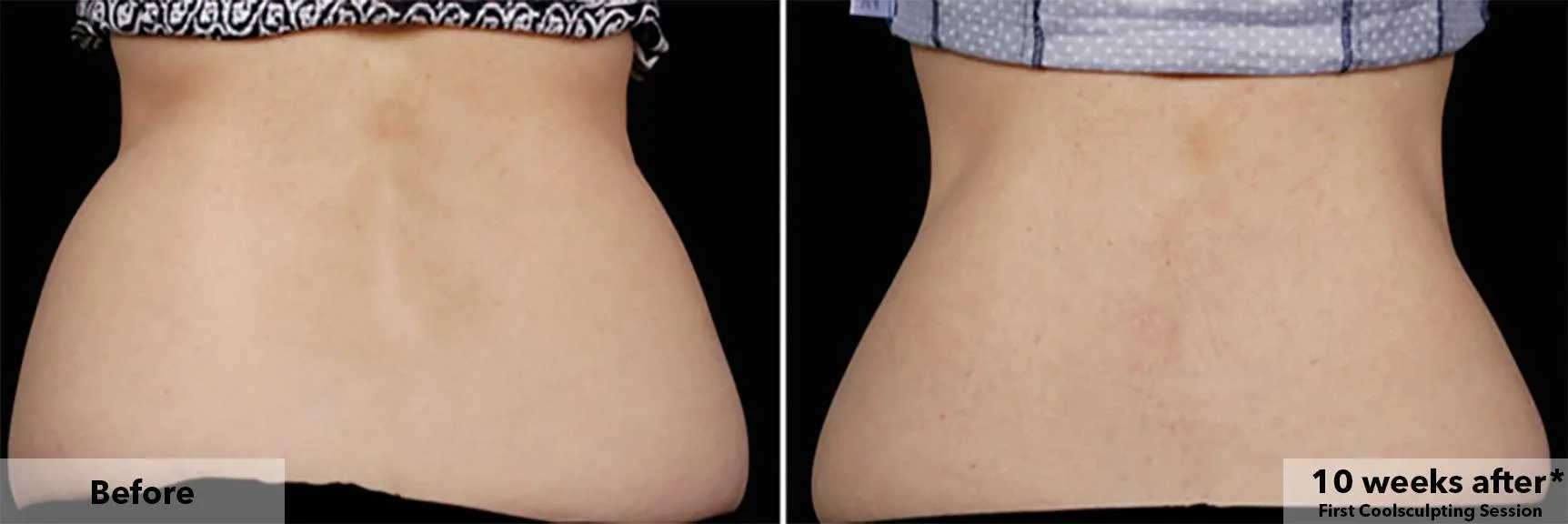 Flanks from behind before and after CoolSculpting fat freezing at Cool Clinic in Amsterdam