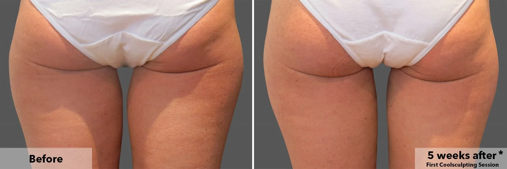 Thighs from behind before and after CoolSculpting fat freezing at Cool Clinic in Amsterdam