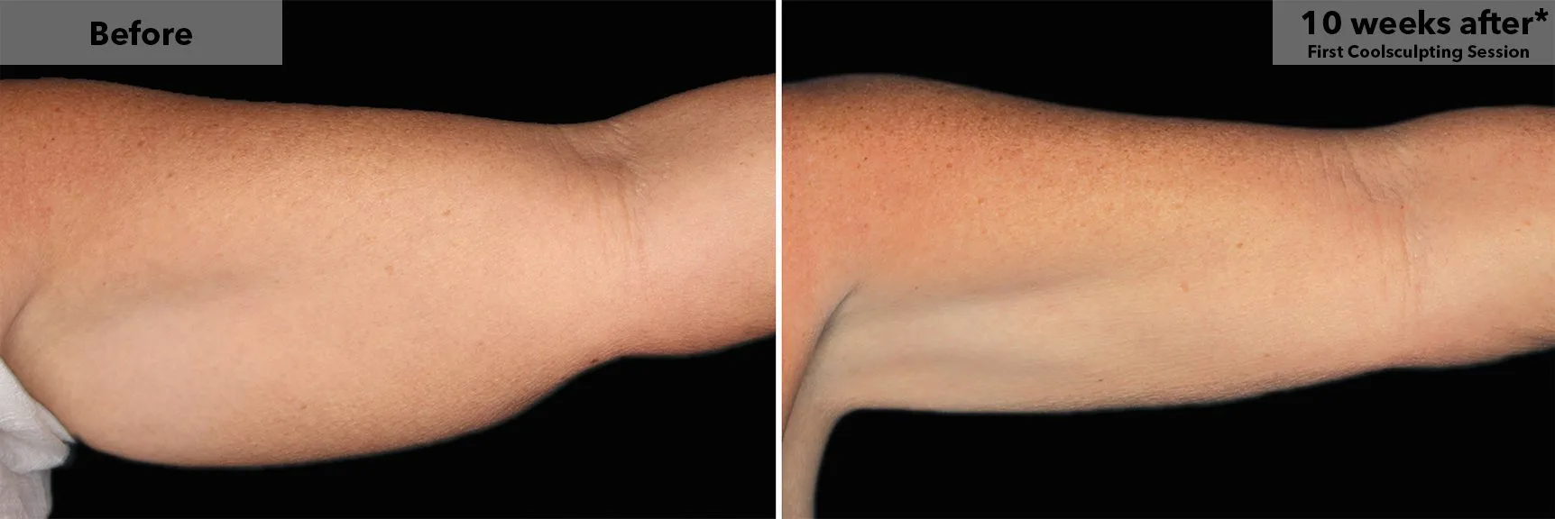 Upper arm before and after CoolSculpting fat freezing at Cool Clinic in Amsterdam