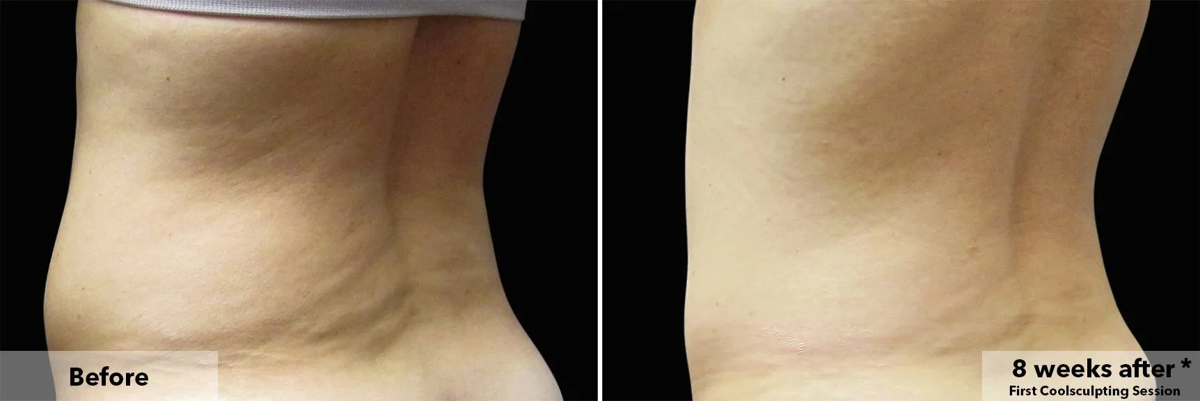 Waist in profile before and after CoolSculpting fat freezing at Cool Clinic in Amsterdam