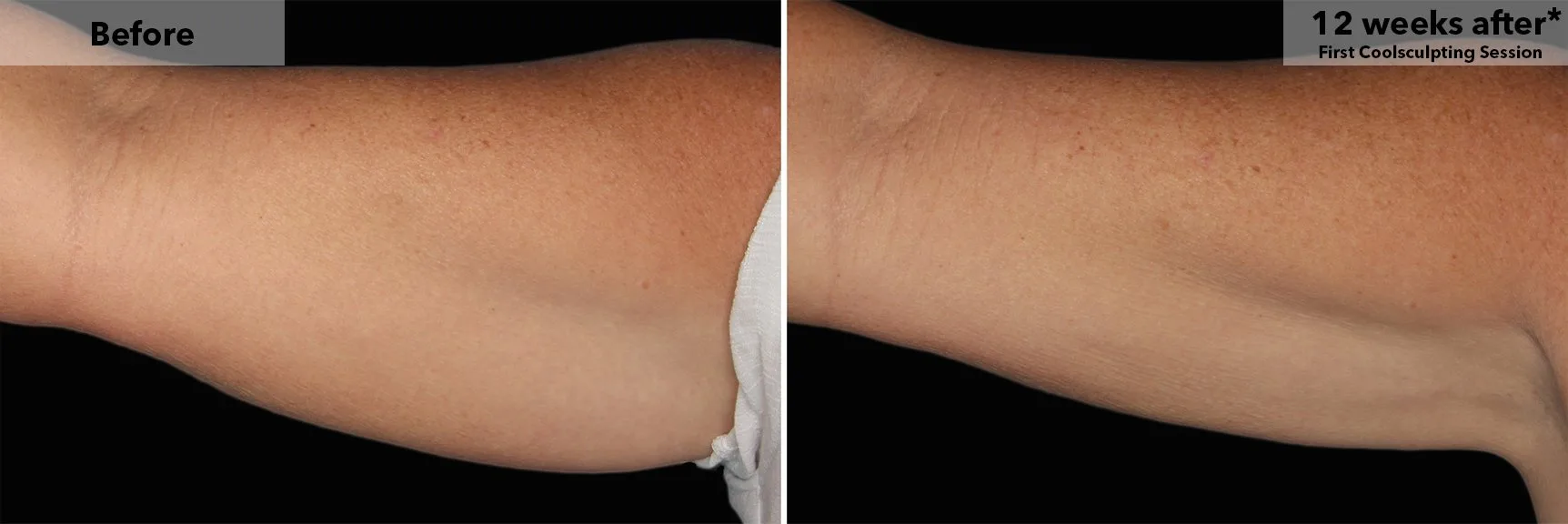 Upper arm before and after CoolSculpting fat freezing at Cool Clinic in Amsterdam
