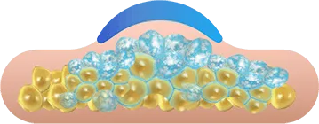 Illustration of fat cells freezing under the applicator for CoolSculpting fat freezing in Amsterdam