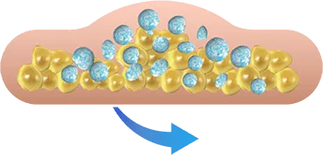 Illustration of the treated area being massaged for CoolSculpting fat freezing in Amsterdam