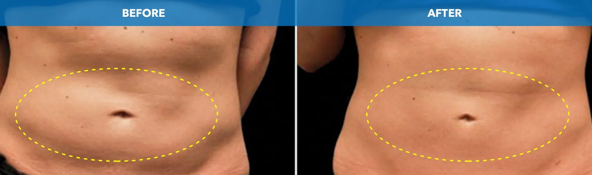 Abdomen with the treated area outlined before and after CoolSculpting fat freezing at Cool Clinic in Amsterdam